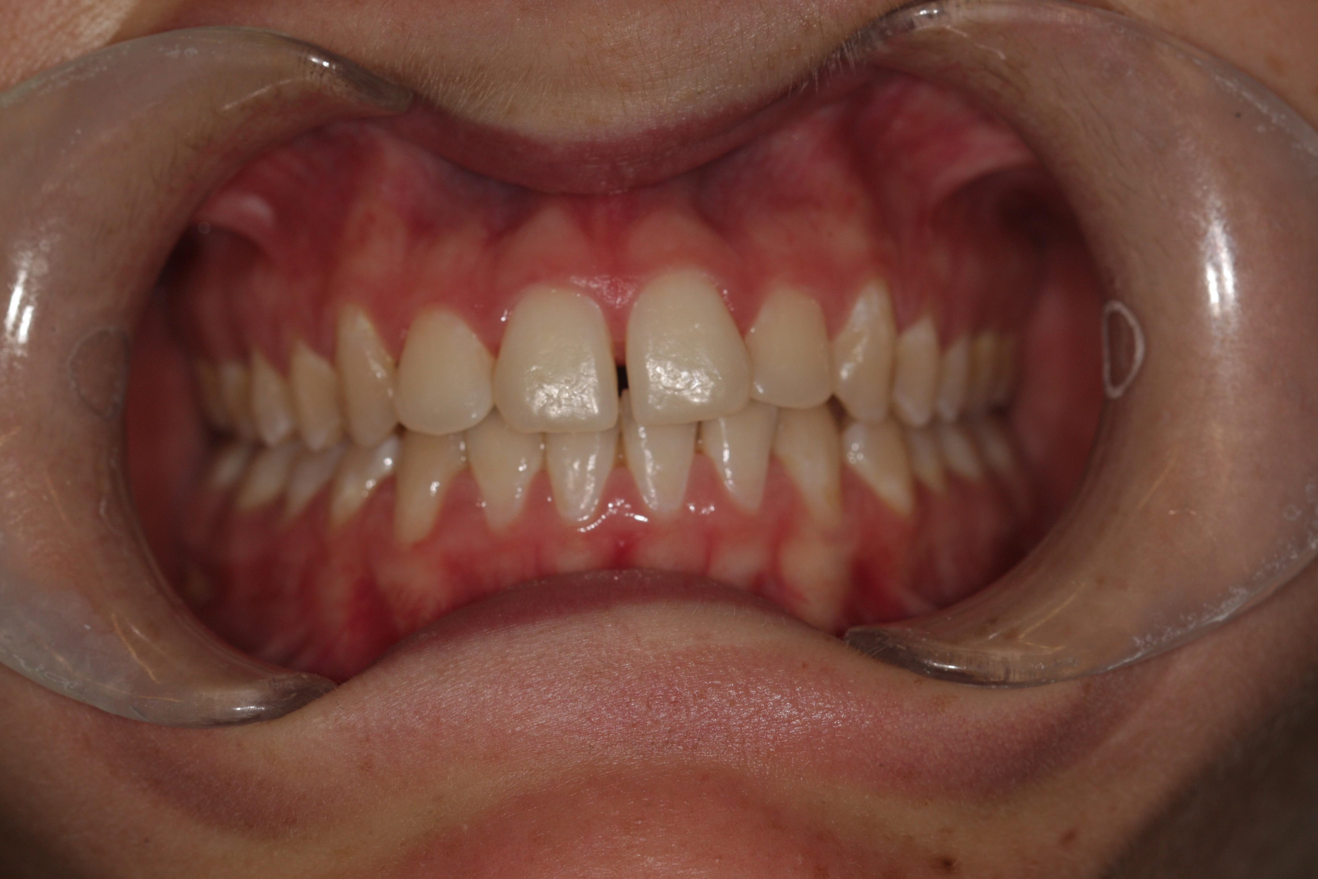 A progress photo of teeth in orthodontic treatment.