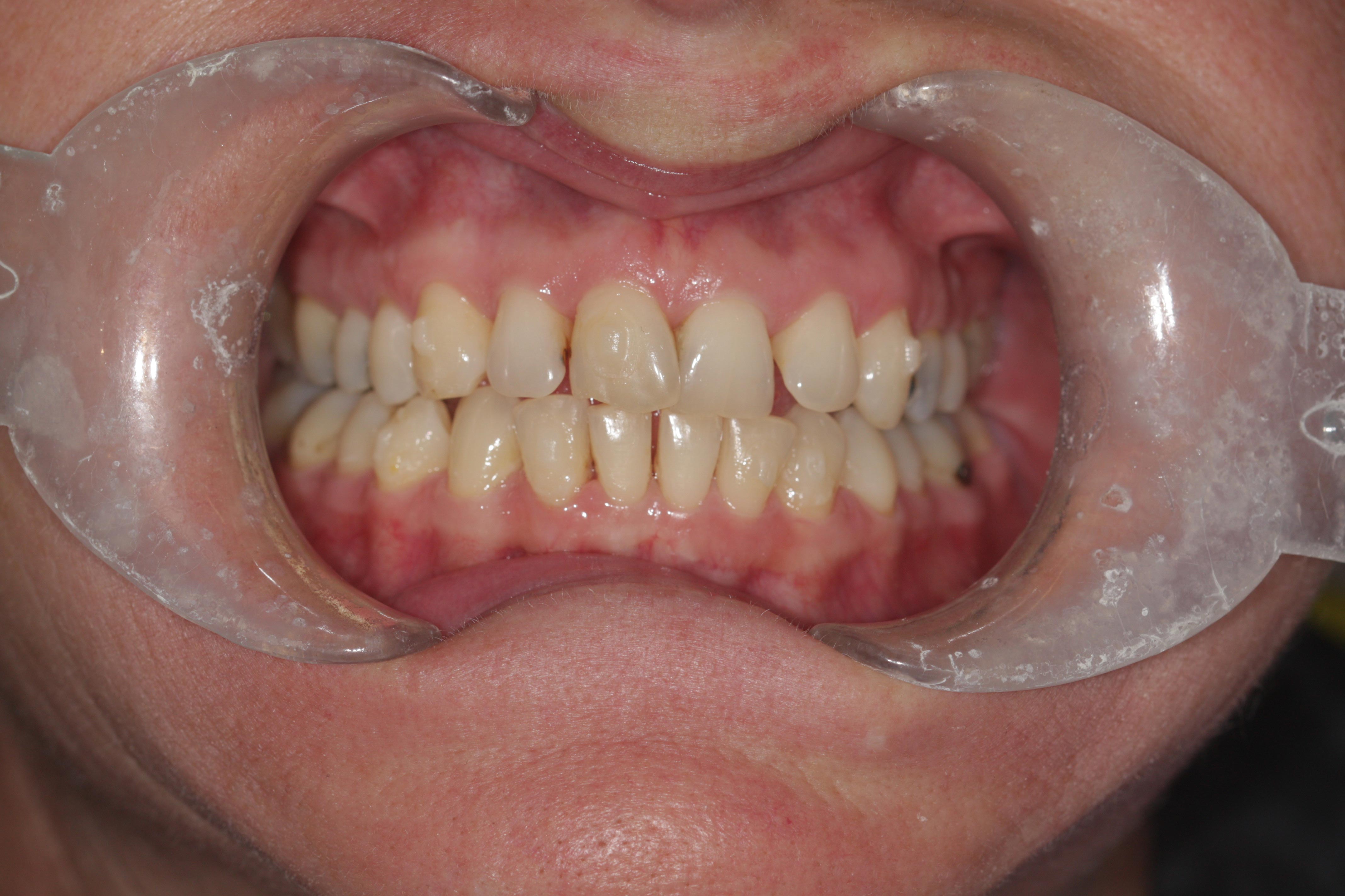 A "before" photo in a clear aligner before and after comparison.