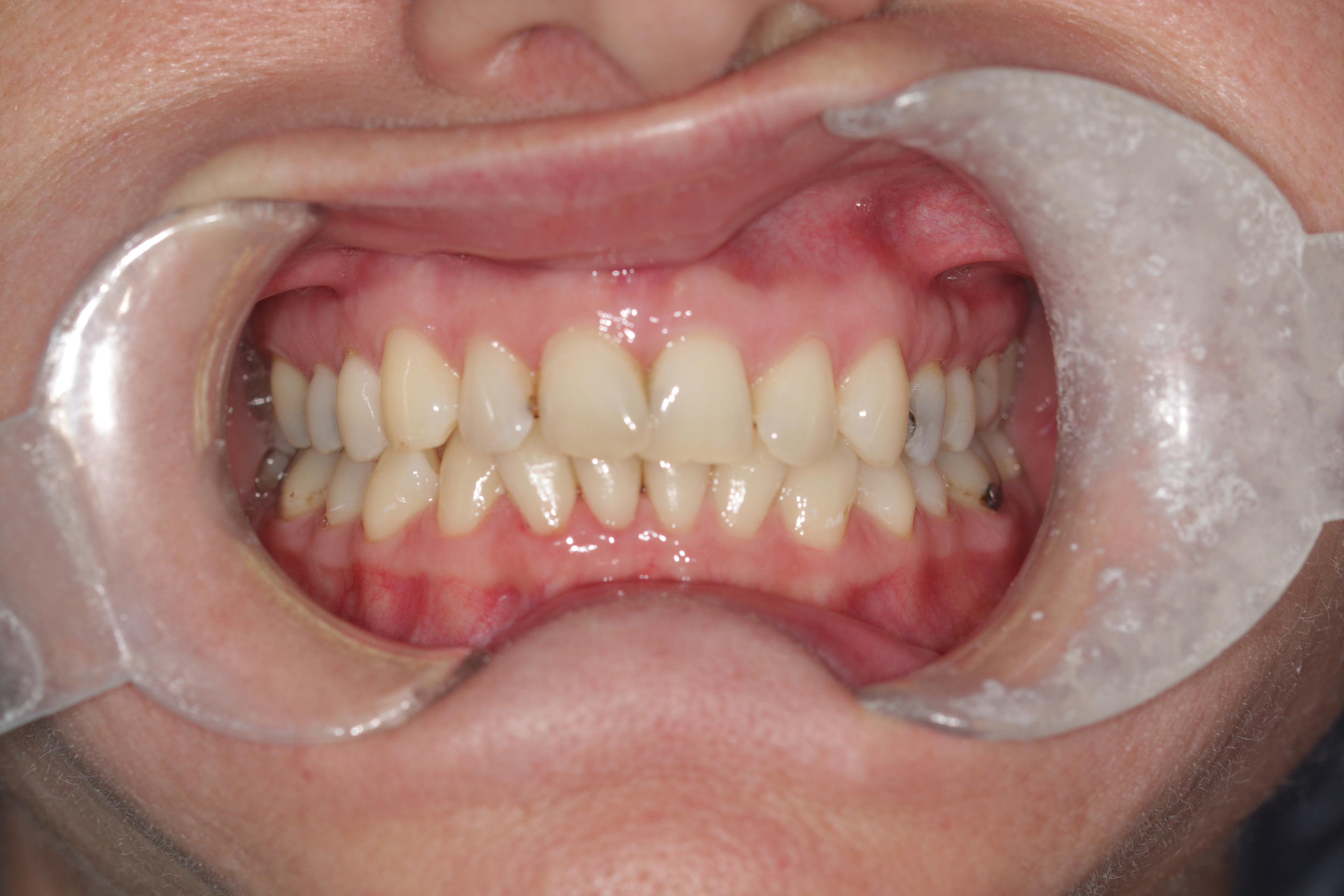 A photo of teeth during an orthodontic treatment.