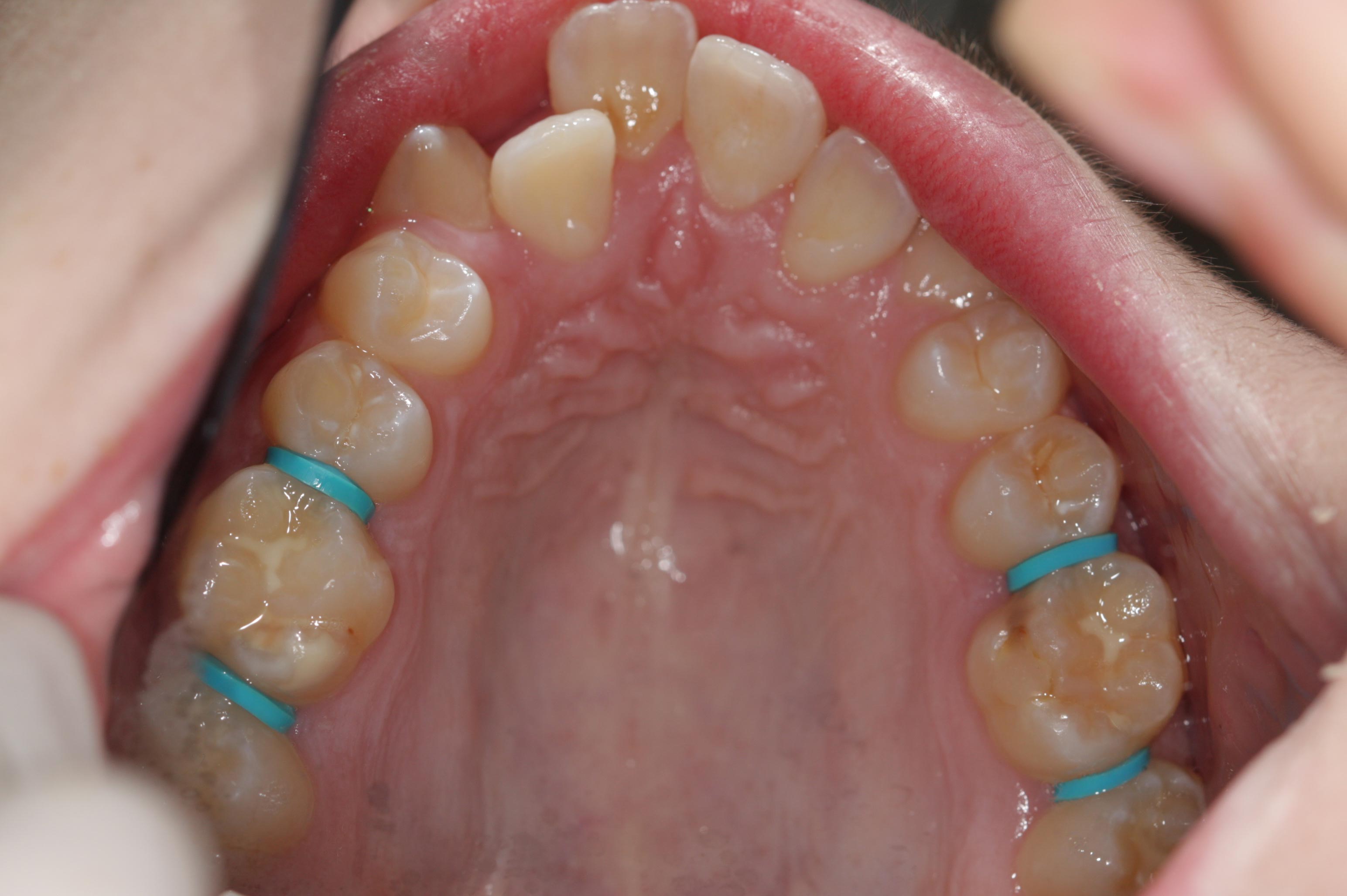 A photo of teeth in the middle of orthodontic treatment.