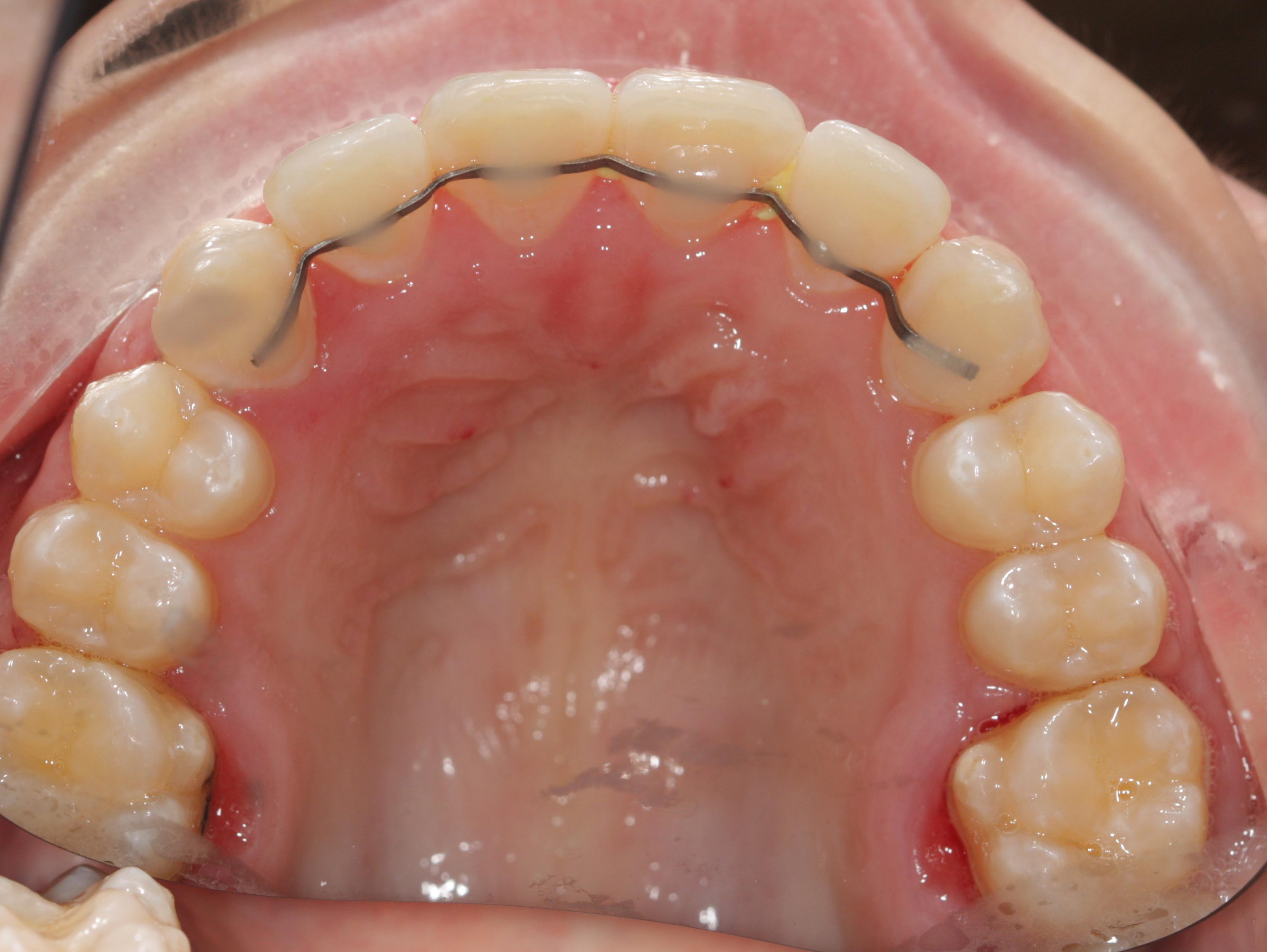 An after photo of teeth after orthodontic treatment. There is a permanent retainer on the teeth.